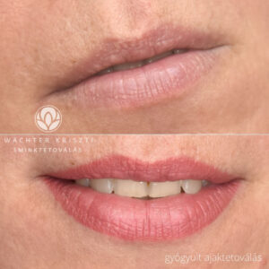 gyogyult ajaktetovalas wachter krisztina koszeg